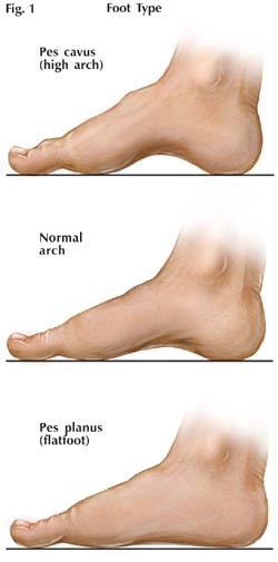 Foot Condition, flat feet, high arch feet, high arch foot, normal arch, heel pain, Arch Height